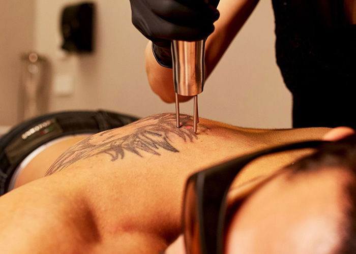 Face of Man client receiving tattoo removal treatment