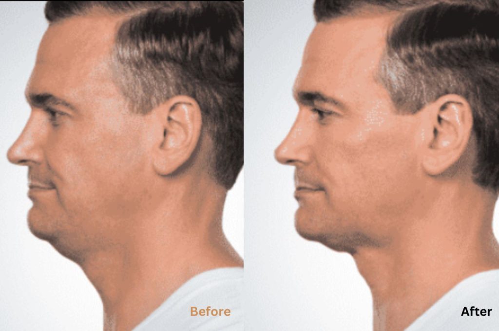 Before and After results from the Defined Jawline & Skin Tightening Package with Francisca