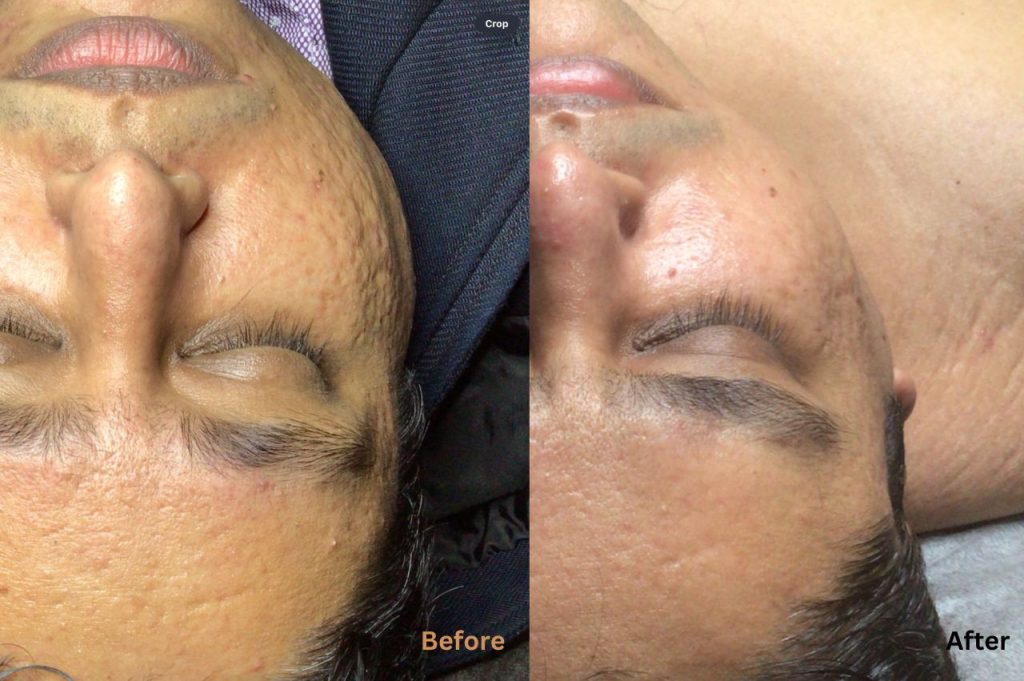 Skin Needling with Grace Before and After Results